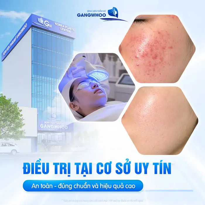 Giá điều trị mụn bao nhiêu? Bảng giá điều trị mụn cập nhật 2025