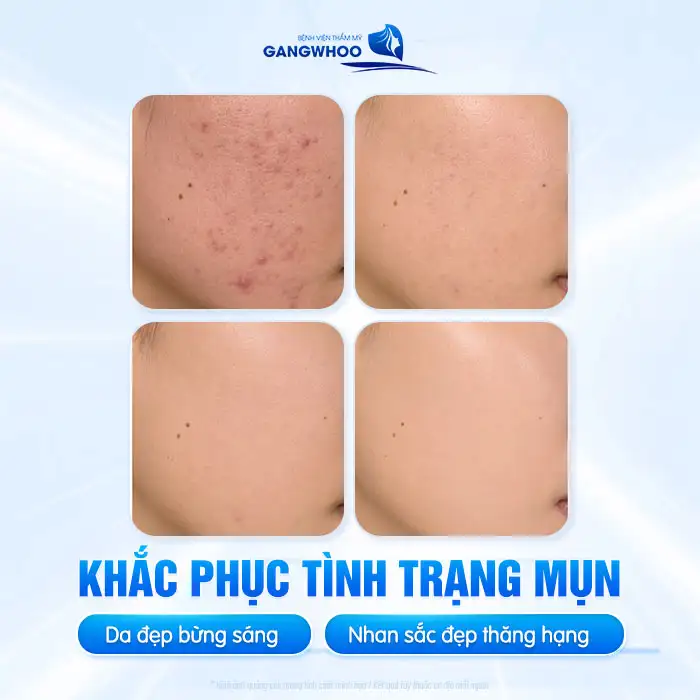 Giá điều trị mụn bao nhiêu? Bảng giá điều trị mụn cập nhật 2025