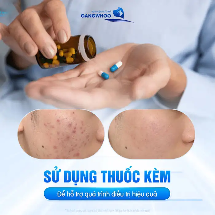 Giá điều trị mụn bao nhiêu? Bảng giá điều trị mụn cập nhật 2025