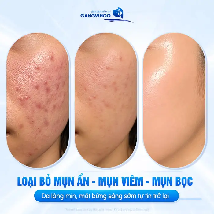 Giá điều trị mụn bao nhiêu? Bảng giá điều trị mụn cập nhật 2025