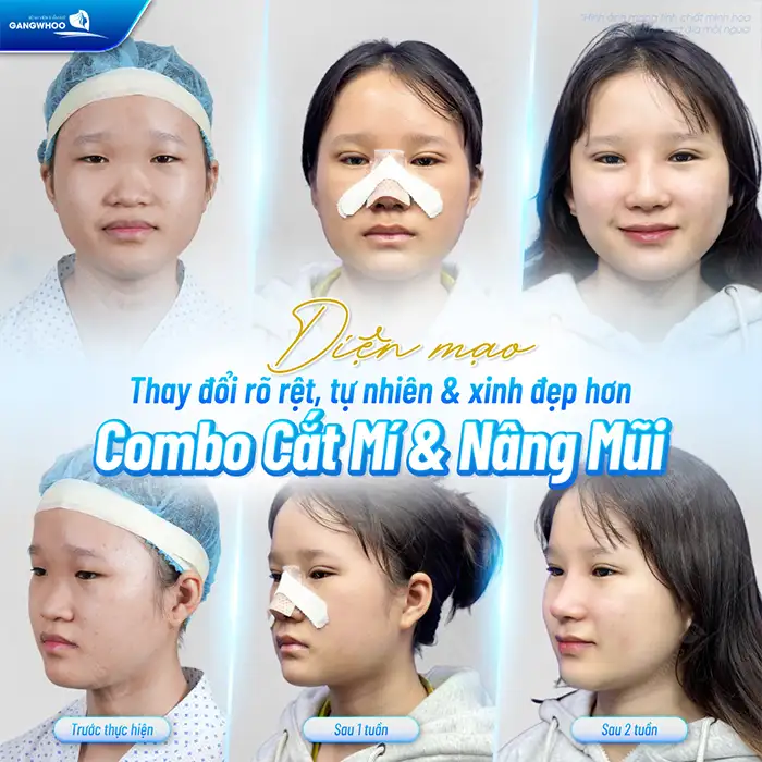 Bao nhiêu tuổi thì cắt mí được? Có nên thực hiện cắt mí sớm