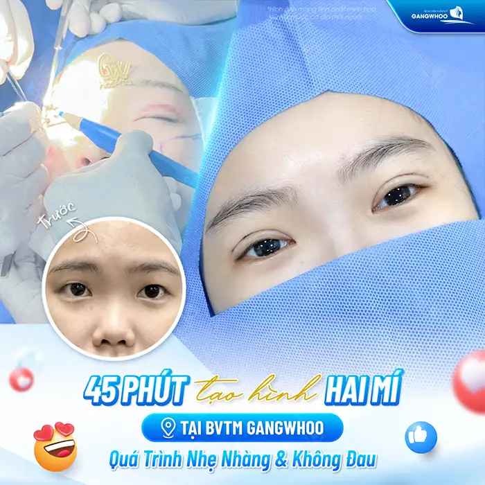 Bao nhiêu tuổi thì cắt mí được? Có nên thực hiện cắt mí sớm