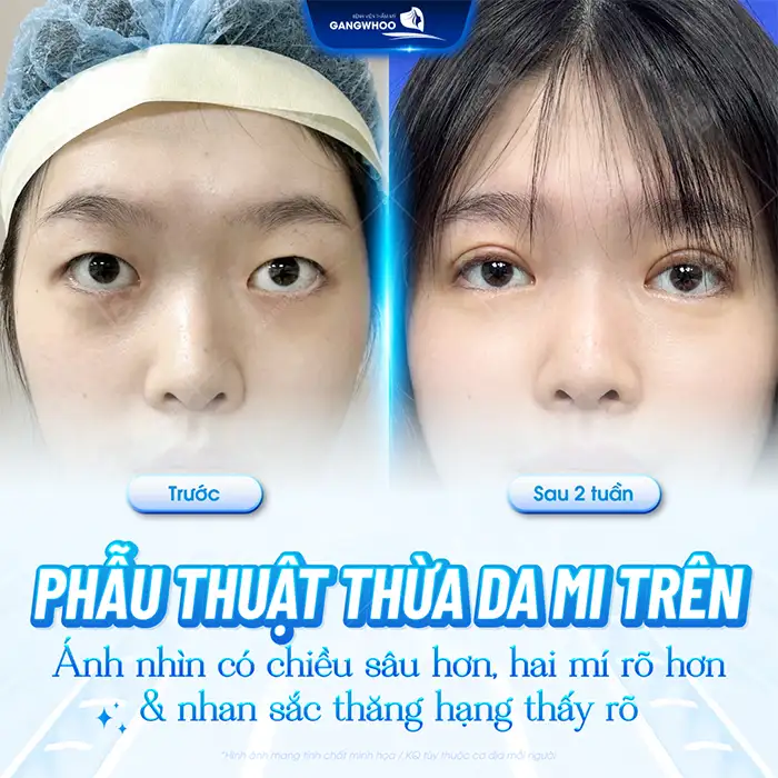 Bao nhiêu tuổi thì cắt mí được? Có nên thực hiện cắt mí sớm