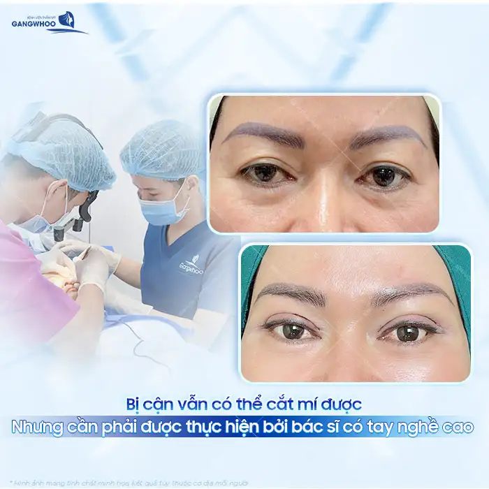 Bị cận có nên cắt mí? Có gây ảnh hưởng đến độ cận không?