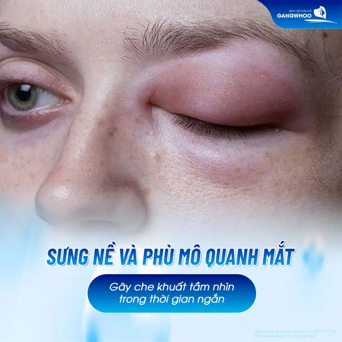 Bị mờ mắt sau khi cắt mí nguyên nhân do đâu? Cách khắc phục hiệu quả