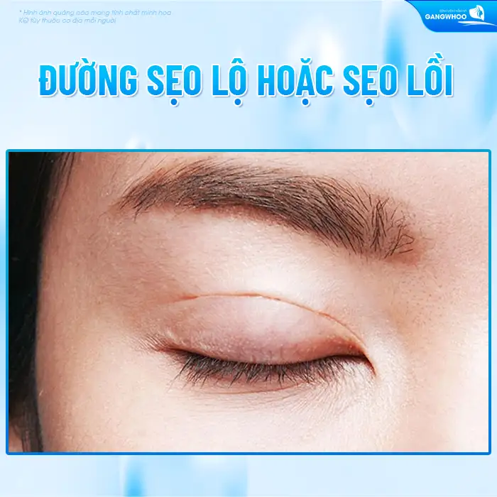 Những biến chứng sau cắt mí có thể gặp là gì? Cách xử lý ra sao?