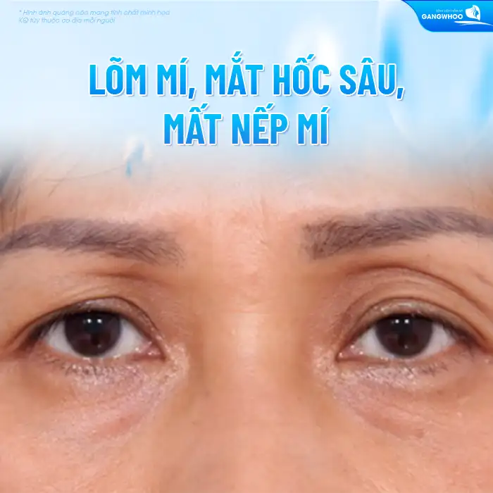 Những biến chứng sau cắt mí có thể gặp là gì? Cách xử lý ra sao?