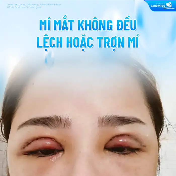 Những biến chứng sau cắt mí có thể gặp là gì? Cách xử lý ra sao?