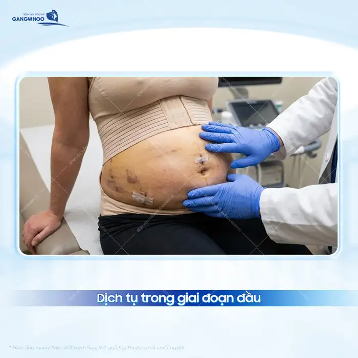 Bụng cứng sau hút mỡ nguyên nhân do đâu? Có phải biến chứng không?