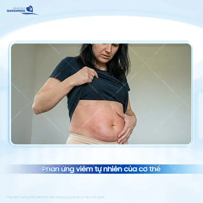 Bụng cứng sau hút mỡ nguyên nhân do đâu? Có phải biến chứng không?