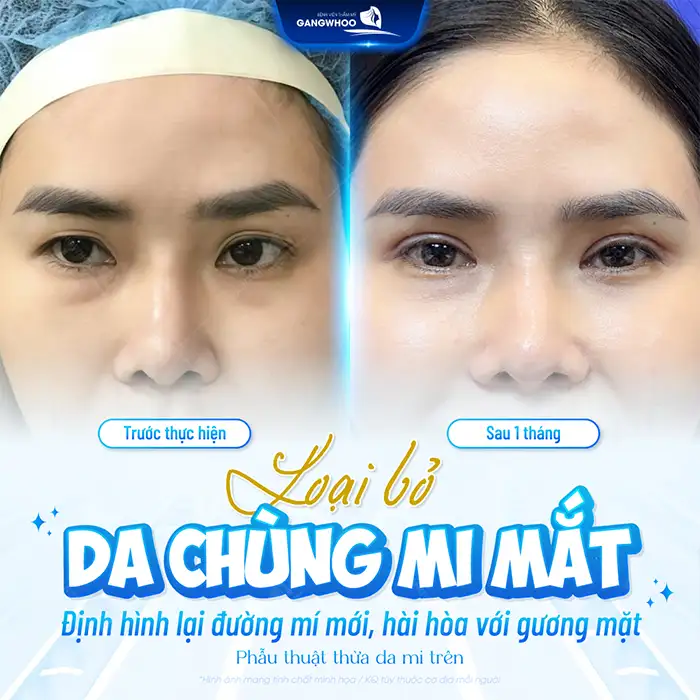 Bật mí top các phương pháp cắt mí có công nghệ cao hiện nay?