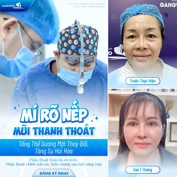 Bật mí top các phương pháp cắt mí có công nghệ cao hiện nay?