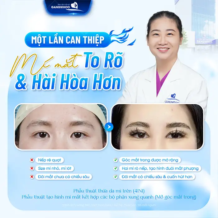 Bật mí top các phương pháp cắt mí có công nghệ cao hiện nay?