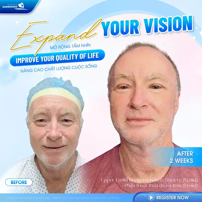 Bật mí top các phương pháp cắt mí có công nghệ cao hiện nay?