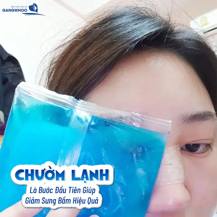 Hướng dẫn cách chườm lạnh sau cắt mí giúp giảm sưng hiệu quả