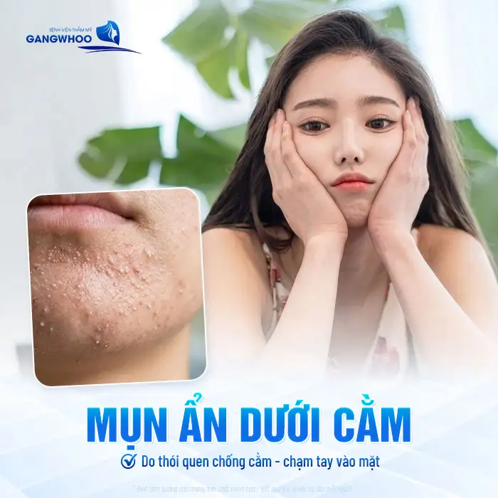 Cách điều trị mụn ẩn dưới cằm an toàn, hiệu quả và không gây đau