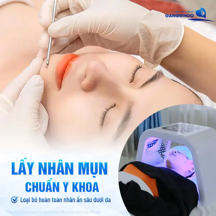 Cách điều trị mụn ẩn dưới cằm an toàn, hiệu quả và không gây đau