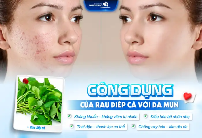Cách điều trị mụn bằng rau diếp cá tại nhà có hiệu quà không?