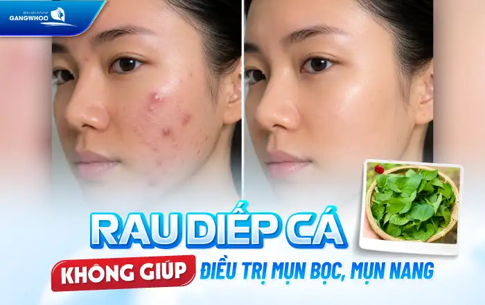 Cách điều trị mụn bằng rau diếp cá tại nhà có hiệu quà không?