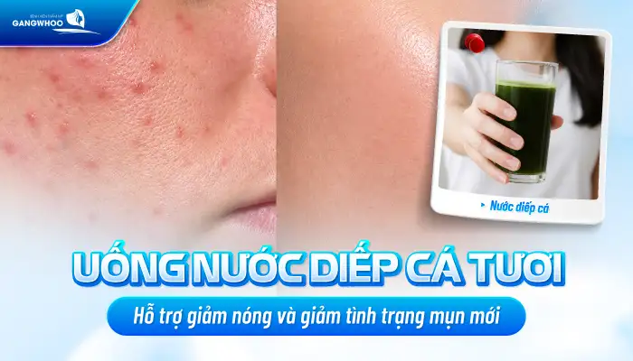 Cách điều trị mụn bằng rau diếp cá tại nhà có hiệu quà không?