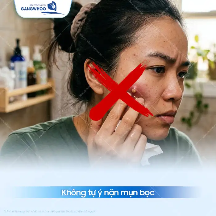 11+ Cách điều trị mụn bọc đúng cách hiệu quả, an toàn cho da mặt