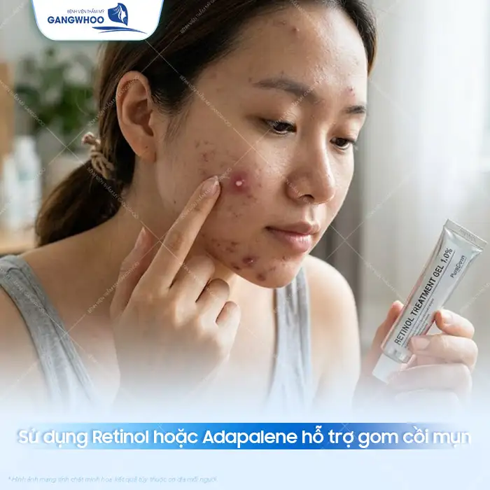 11+ Cách điều trị mụn bọc đúng cách hiệu quả, an toàn cho da mặt