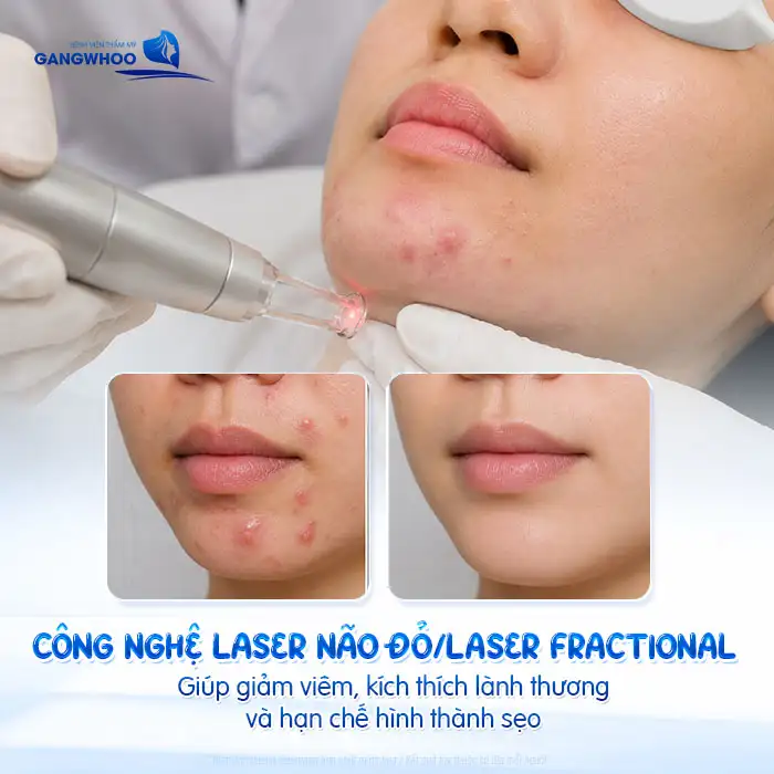 Cách điều trị mụn bọc ở cằm: Giảm sưng nhanh – Ngừa thâm sẹo