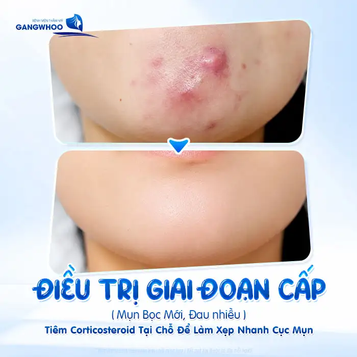 Cách điều trị mụn bọc ở cằm: Giảm sưng nhanh – Ngừa thâm sẹo