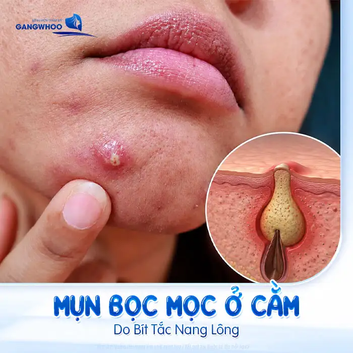 Cách điều trị mụn bọc ở cằm: Giảm sưng nhanh – Ngừa thâm sẹo