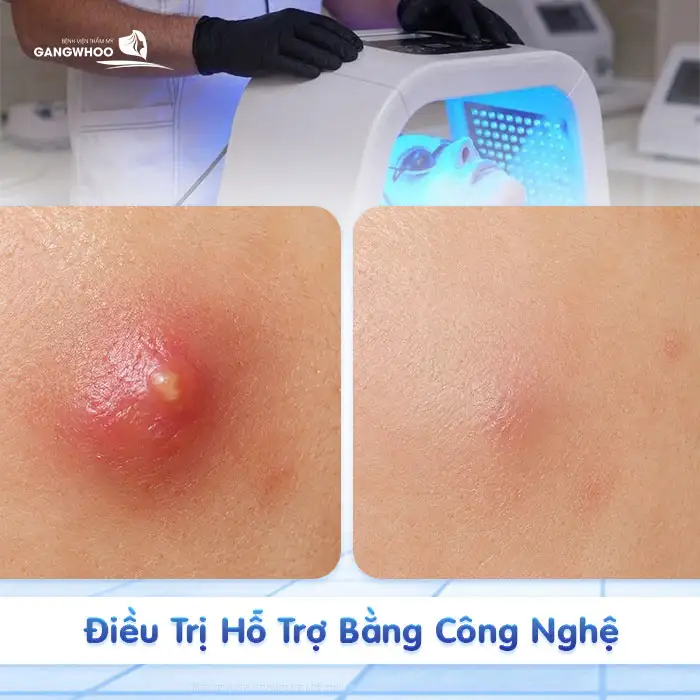 Cách điều trị mụn bọc ở má để giảm sưng nhanh và tránh thâm sẹo