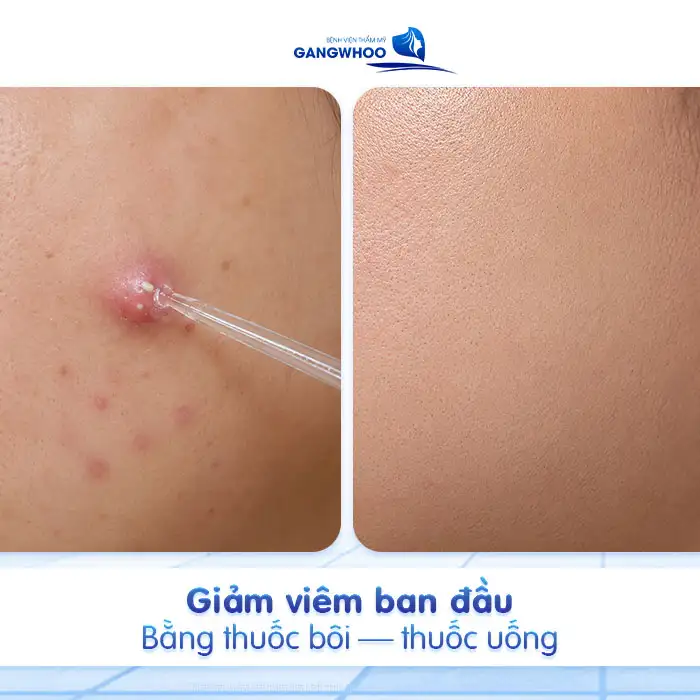 Cách điều trị mụn bọc ở má để giảm sưng nhanh và tránh thâm sẹo