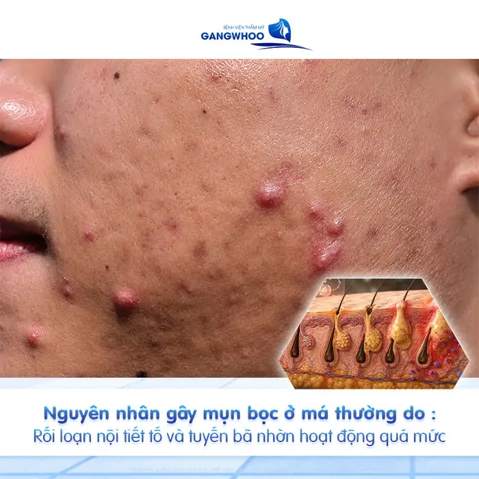 Cách điều trị mụn bọc ở má để giảm sưng nhanh và tránh thâm sẹo