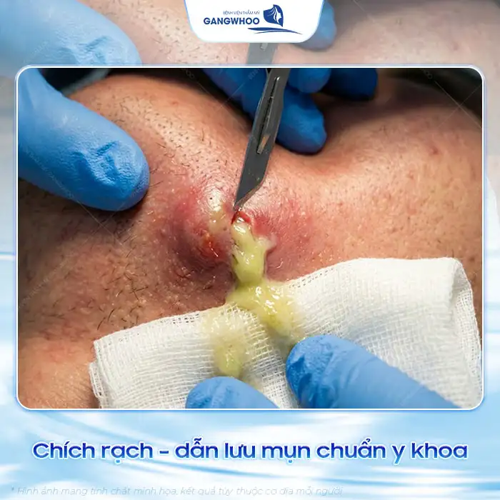 Cách điều trị mụn bọc ở mũi hiệu quả và an toàn, không để lại sẹo