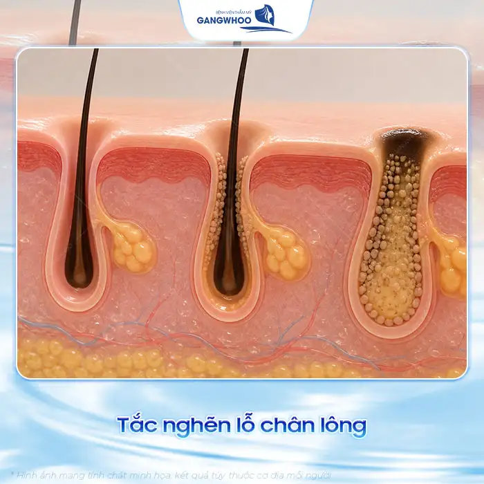 Cách điều trị mụn bọc ở mũi hiệu quả và an toàn, không để lại sẹo