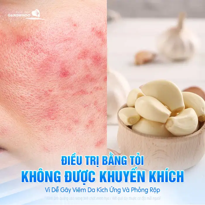Cách điều trị mụn cóc bằng tỏi có hiệu quả không? Có nên thực hiện?