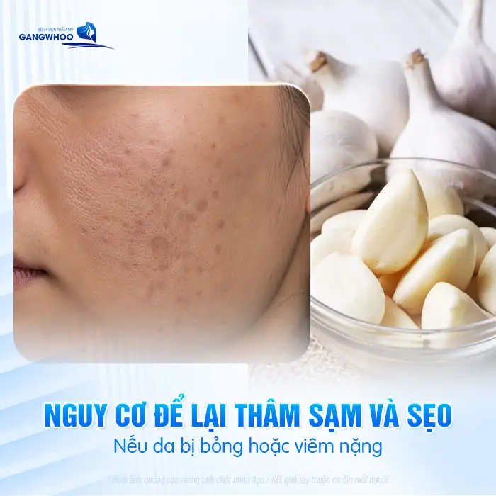 Cách điều trị mụn cóc bằng tỏi có hiệu quả không? Có nên thực hiện?