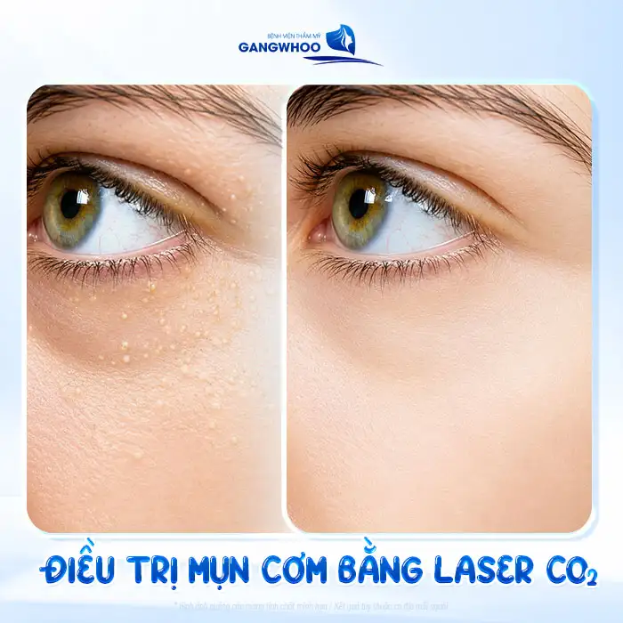 Tham khảo cách điều trị mụn cơm hiệu quả không đau và an toàn