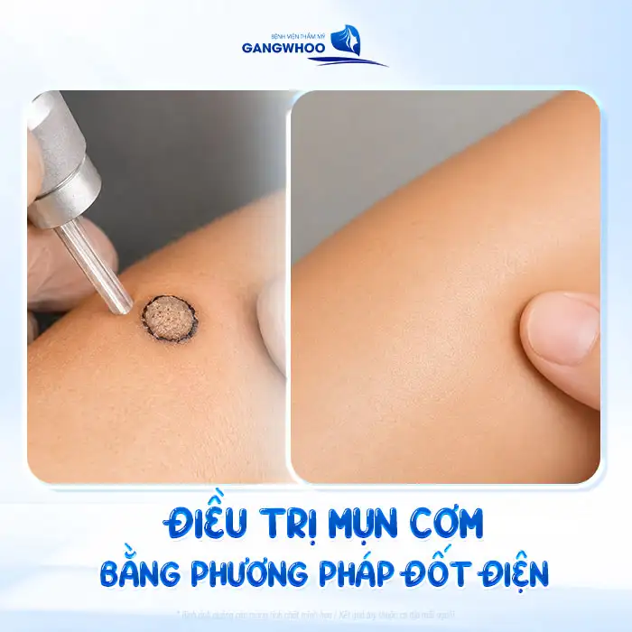 Tham khảo cách điều trị mụn cơm hiệu quả không đau và an toàn