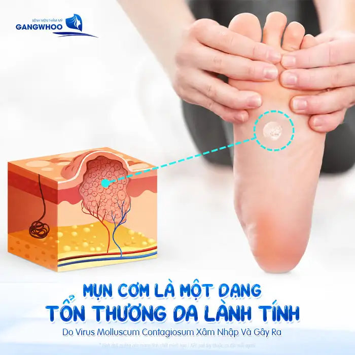 Tham khảo cách điều trị mụn cơm hiệu quả không đau và an toàn