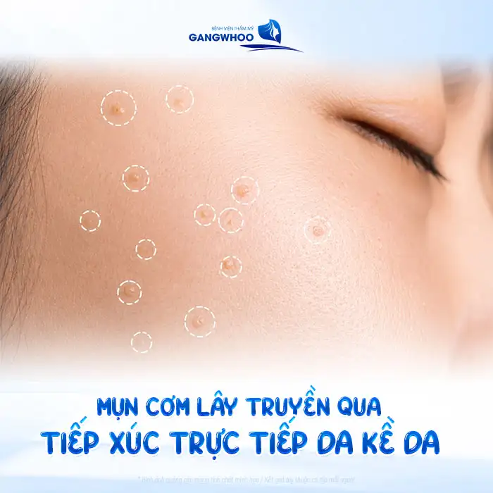 Tham khảo cách điều trị mụn cơm hiệu quả không đau và an toàn