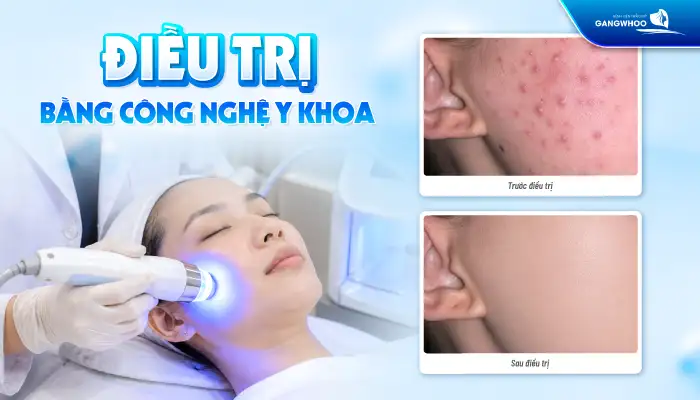 Cách điều trị mụn dạng cục an toàn và hiệu quả theo phác chuẩn y khoa