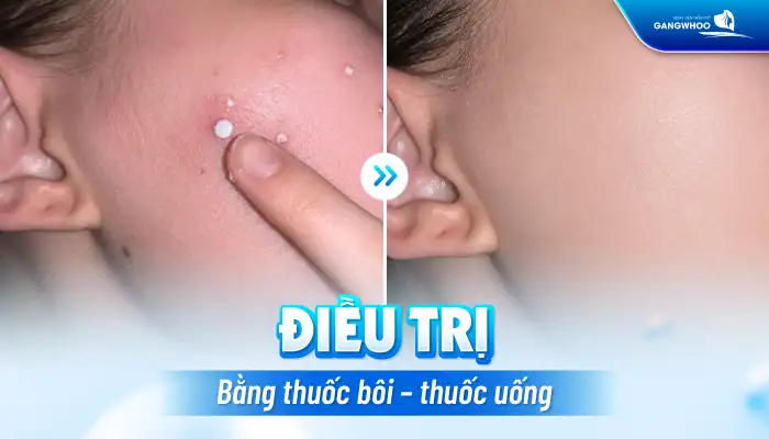 Cách điều trị mụn dạng cục an toàn và hiệu quả theo phác chuẩn y khoa