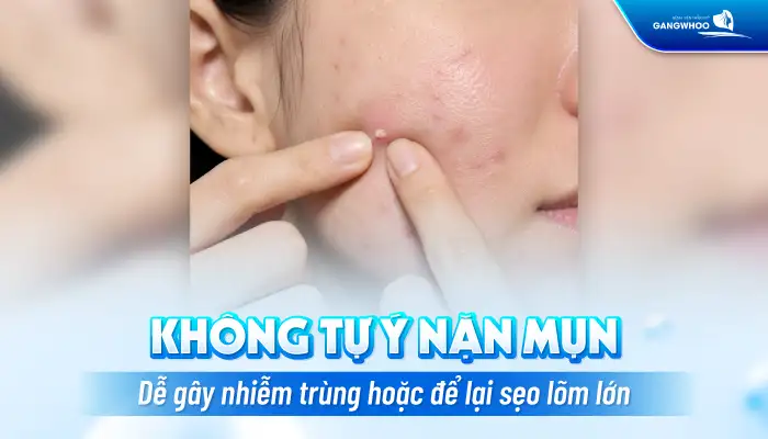 Cách điều trị mụn dạng cục an toàn và hiệu quả theo phác chuẩn y khoa