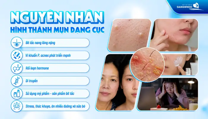 Cách điều trị mụn dạng cục an toàn và hiệu quả theo phác chuẩn y khoa