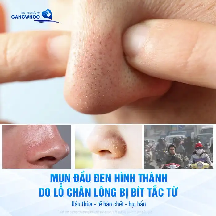 Cách điều trị mụn đầu đen trên mũi an toàn, không làm giãn lỗ chân lông