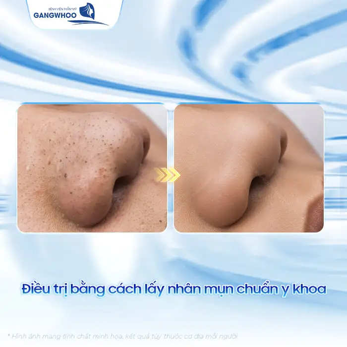Cách điều trị mụn bọc không đầu nhanh xẹp, an toàn tại nhà