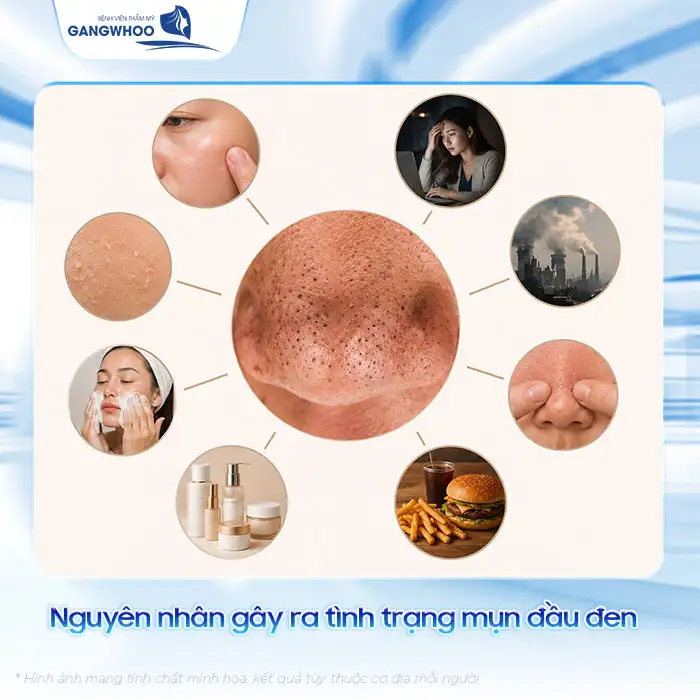 Cách điều trị mụn bọc không đầu nhanh xẹp, an toàn tại nhà