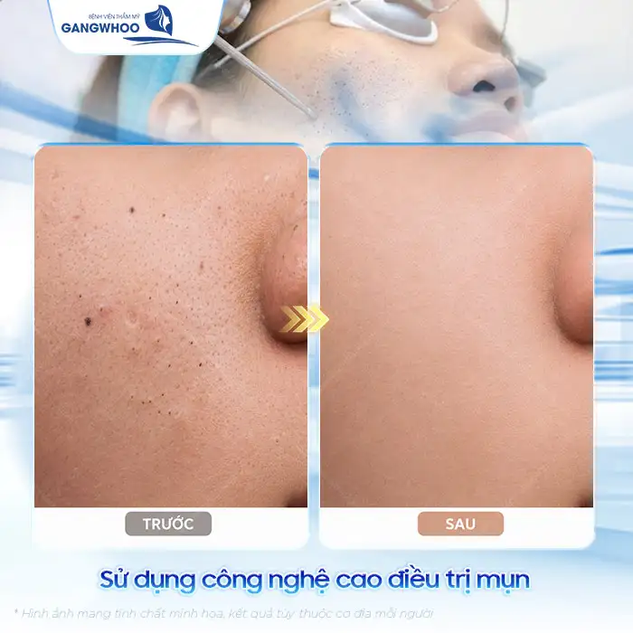Cách điều trị mụn bọc không đầu nhanh xẹp, an toàn tại nhà