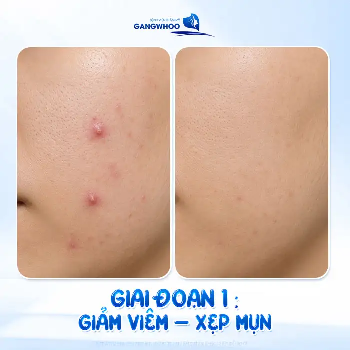 Cách điều trị mụn bọc không đầu nhanh xẹp, an toàn tại nhà