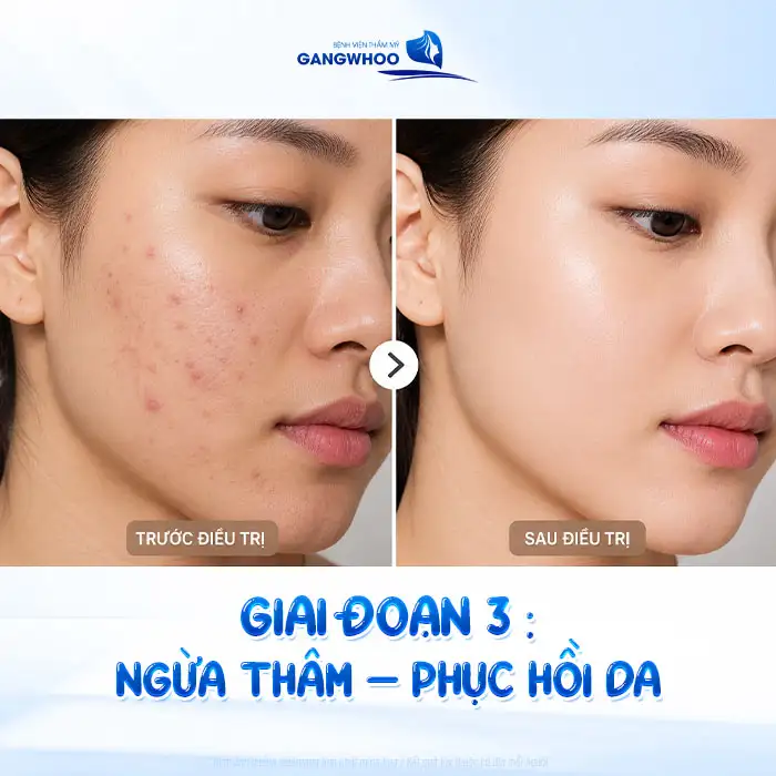 Cách điều trị mụn bọc không đầu nhanh xẹp, an toàn tại nhà